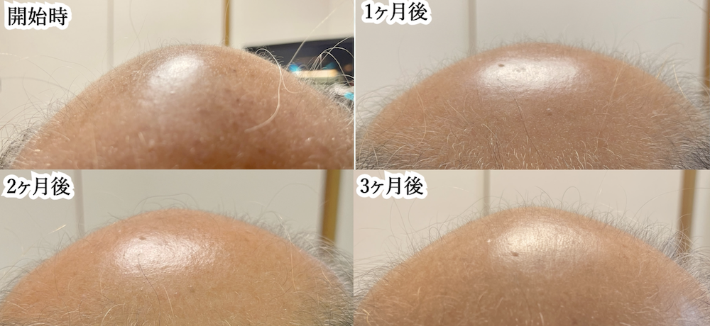育毛へルメット 効果