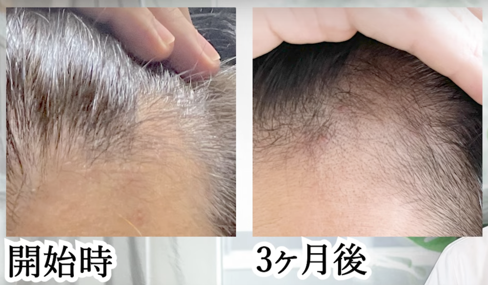赤色LED 育毛 効果 育毛ヘルメット